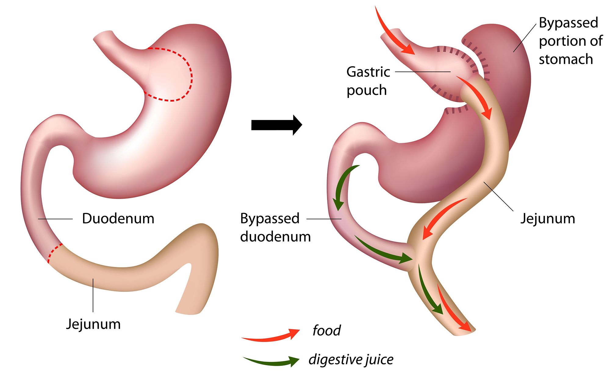 Gastric Bypass Surgery MU Health Care Columbia MO