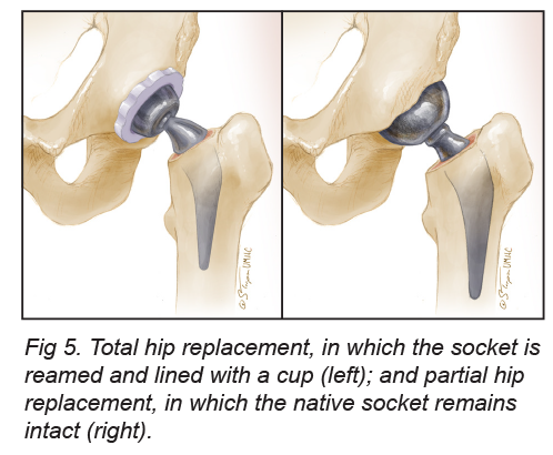 About Hip Replacement - MU Health Care