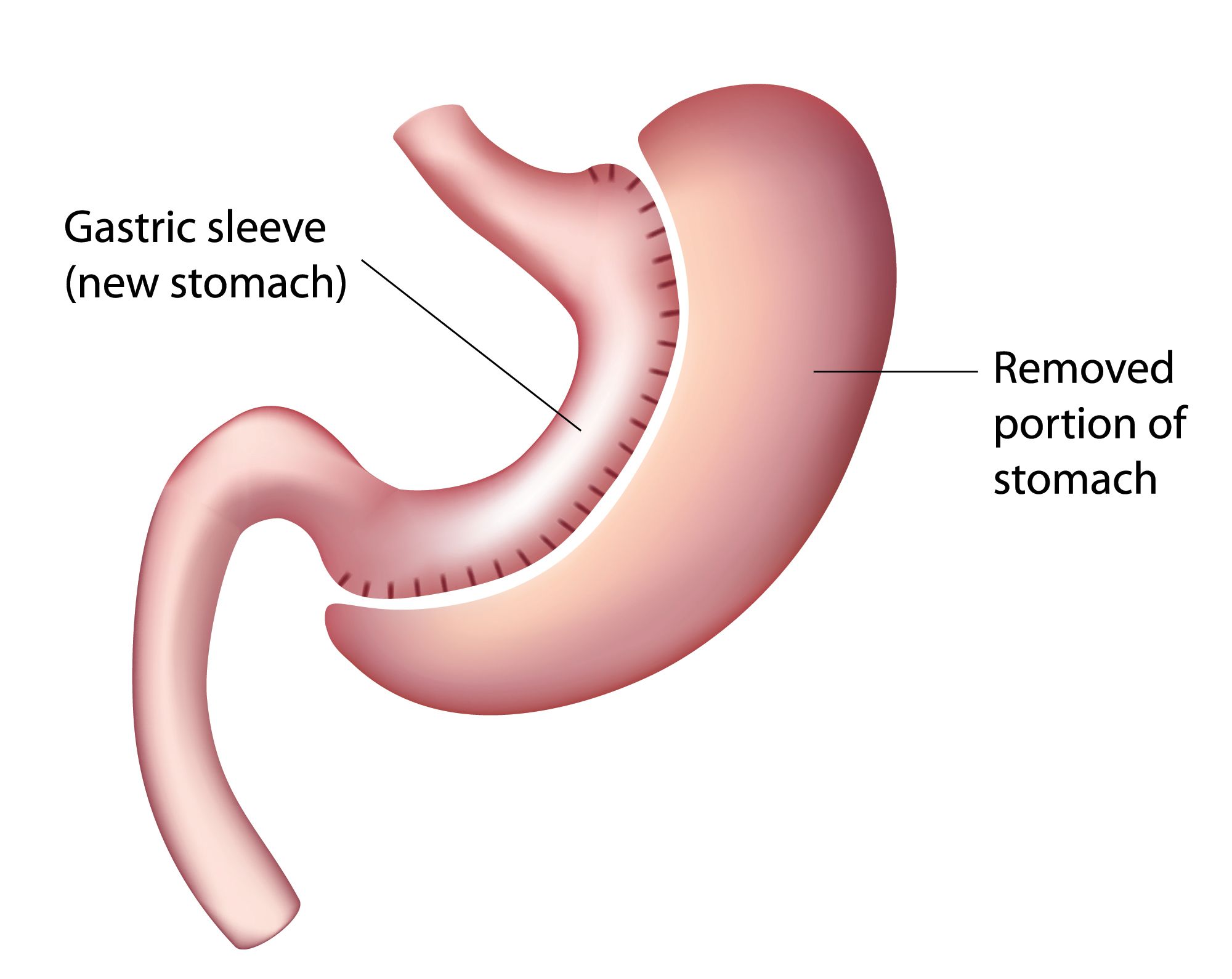 Gastric Sleeve Surgery MU Health Care Columbia MO