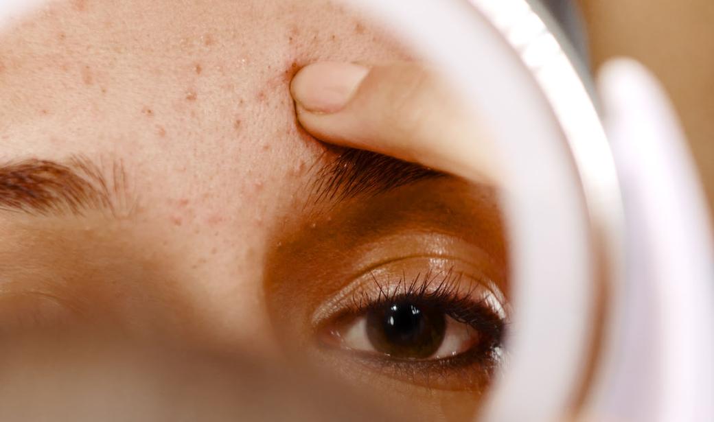 A person looking in a mirror at facial acne.